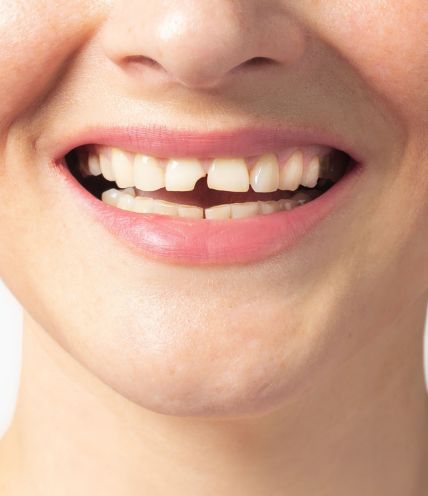 Broken Teeth