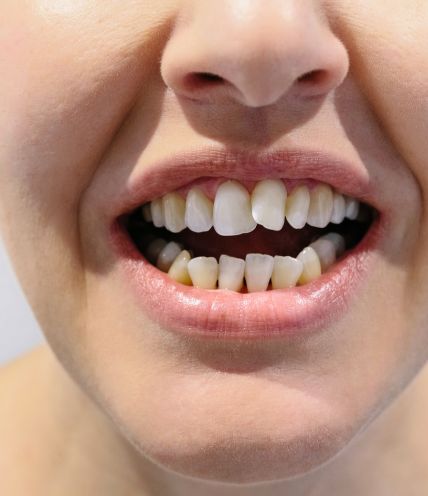 Crooked Teeth