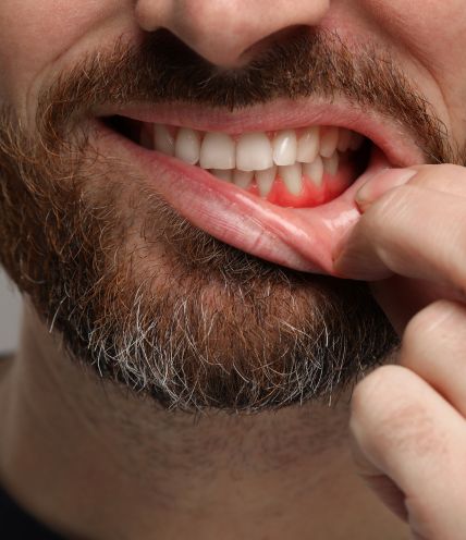 Gum Disease