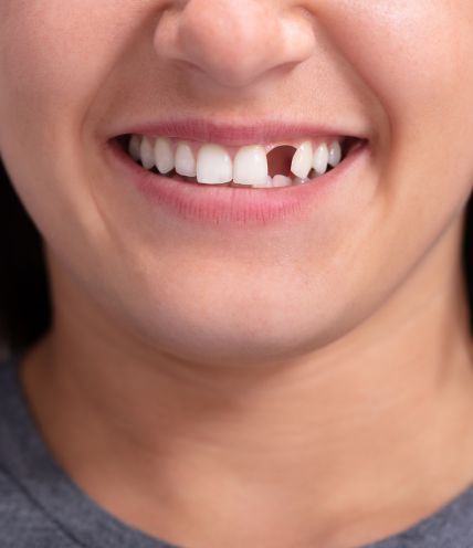 Missing Teeth