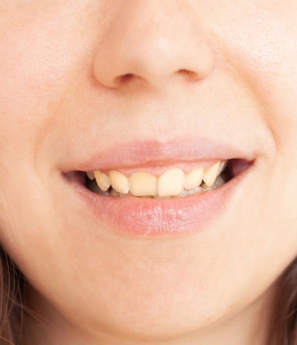Stained Teeth