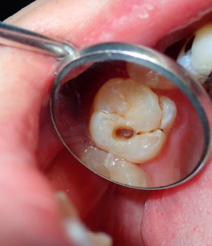 Tooth Decay