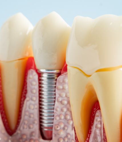 Dental Implants