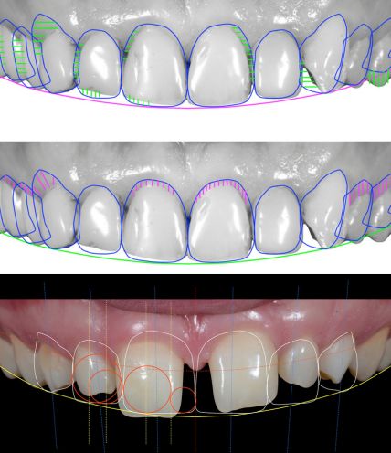Smile Design