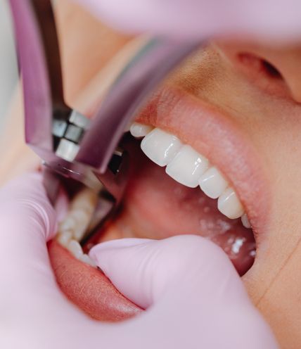Tooth Extractions