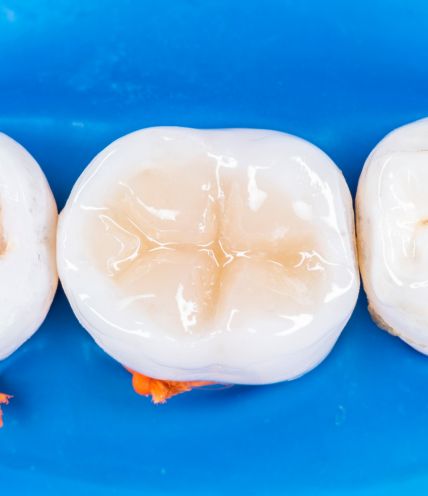 Tooth-Coloured Fillings