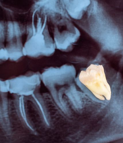 Wisdom Teeth Extractions